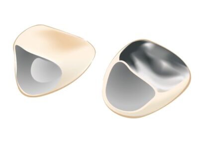 硬質レジン前装冠