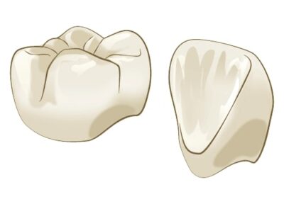 ハイブリッドセラミッククラウン