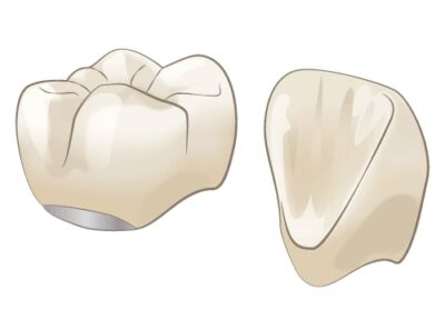 メタルボンドセラミッククラウン