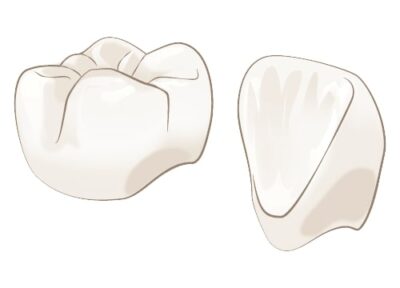 フルジルコニアクラウン