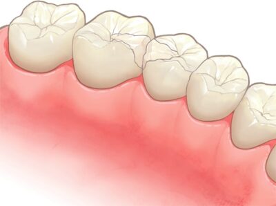 ハイブリッドインレー