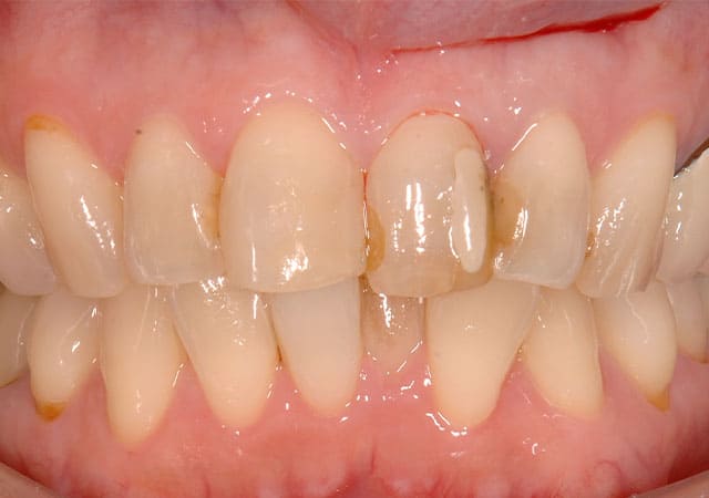 審美治療症例写真（治療前）