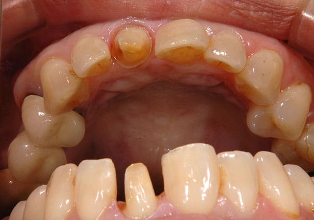 審美治療症例写真（虫歯除去後）