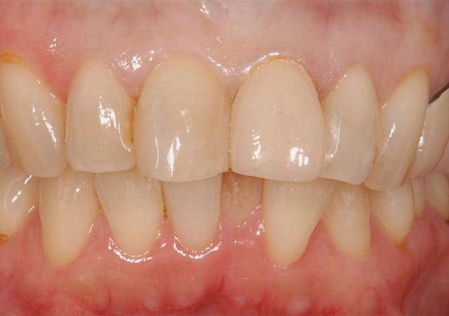審美治療症例写真（仮歯）