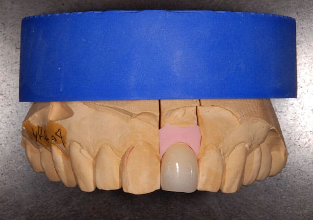 審美治療症例写真（補綴物01）