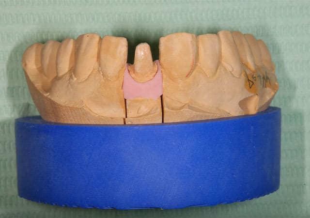 審美治療症例写真（補綴物02）