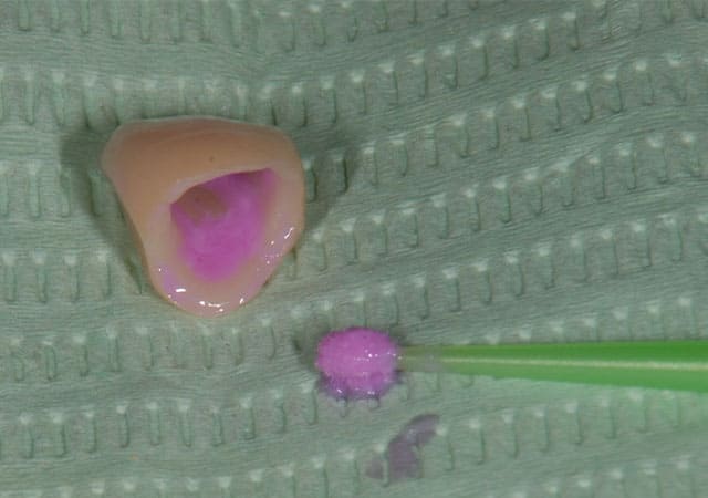 審美治療症例写真（かぶせもの）