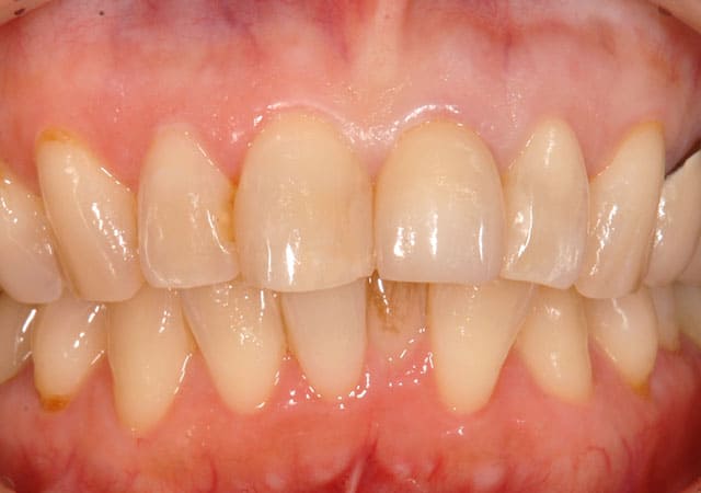 審美治療症例写真（治療後）