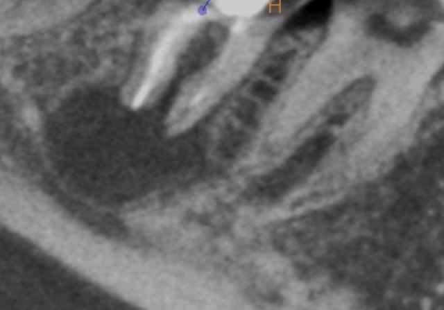 根幹治療の症例写真