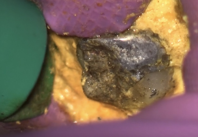 根幹治療の症例写真