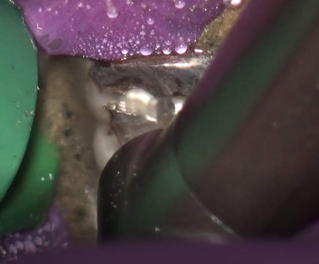 根幹治療の症例写真