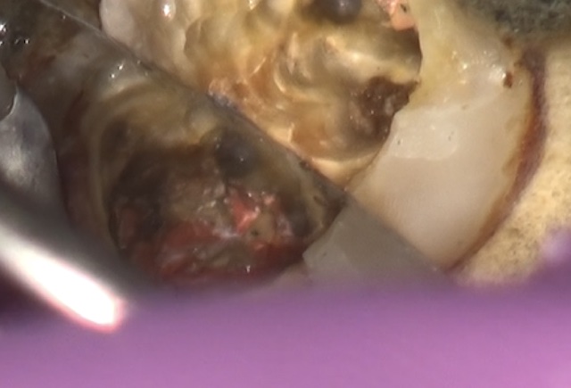 根幹治療の症例写真