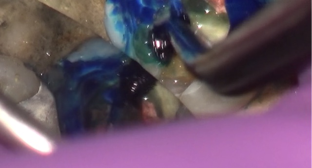 根幹治療の症例写真