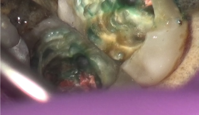 根幹治療の症例写真