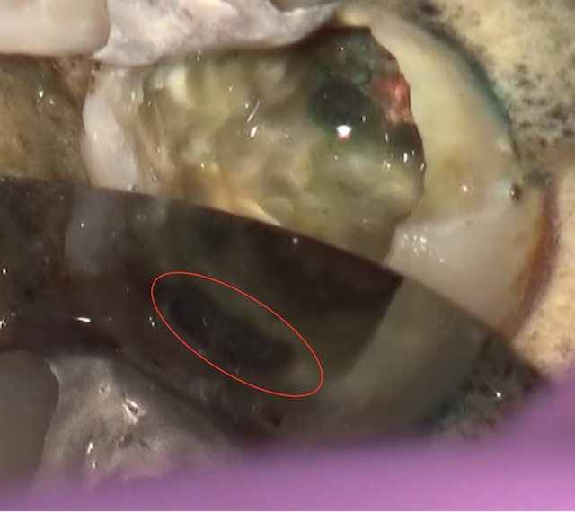 根幹治療の症例写真