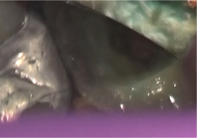 根幹治療の症例写真