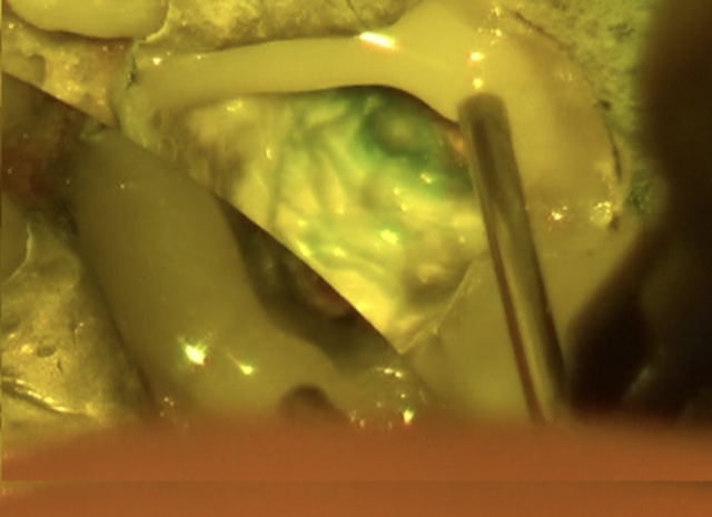 根幹治療の症例写真