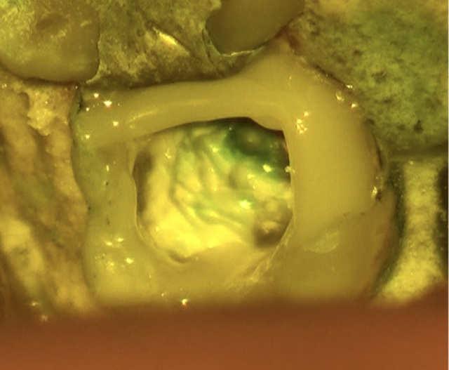 根幹治療の症例写真