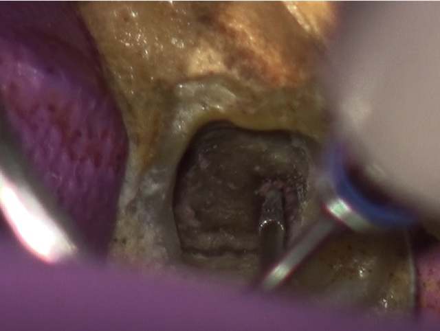 根幹治療の症例写真