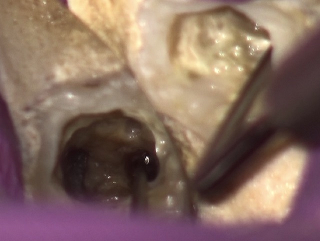 根幹治療の症例写真