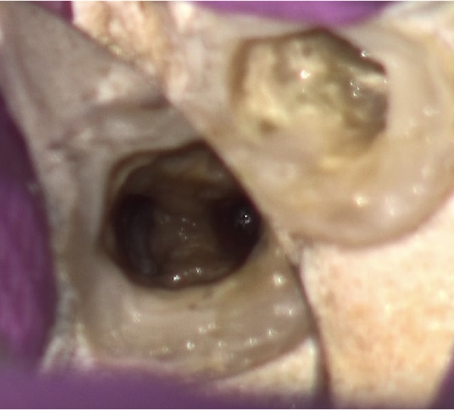 根幹治療の症例写真