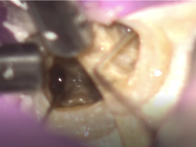 根幹治療の症例写真