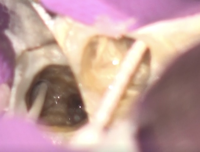 根幹治療の症例写真