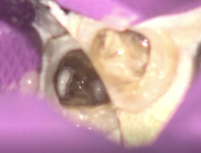 根幹治療の症例写真