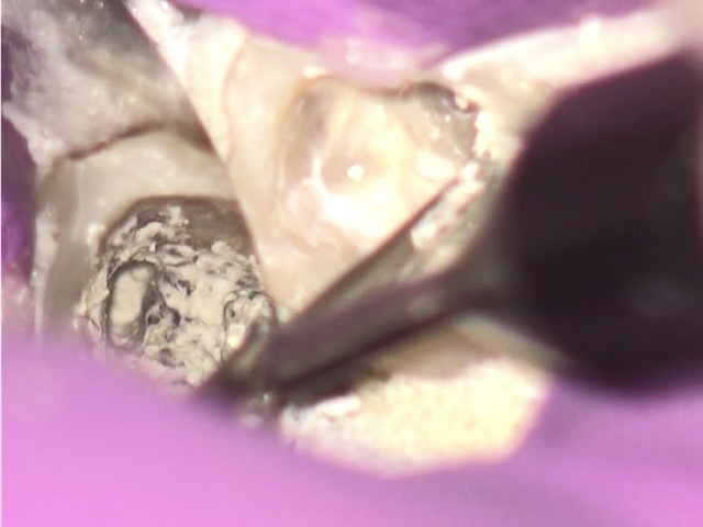 根幹治療の症例写真