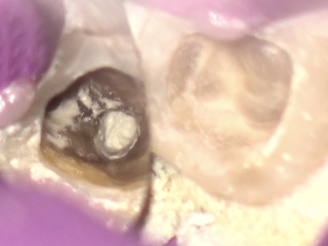 根幹治療の症例写真