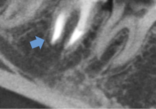 根幹治療の症例写真