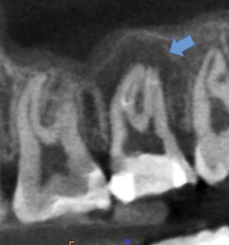 根幹治療の症例写真