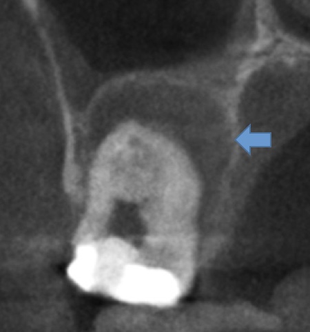 根幹治療の症例写真