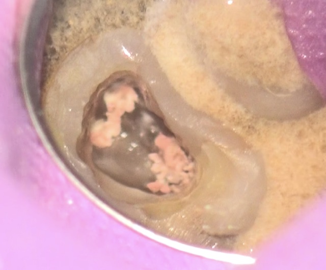 根幹治療の症例写真