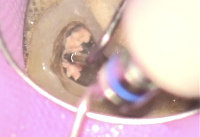 根幹治療の症例写真