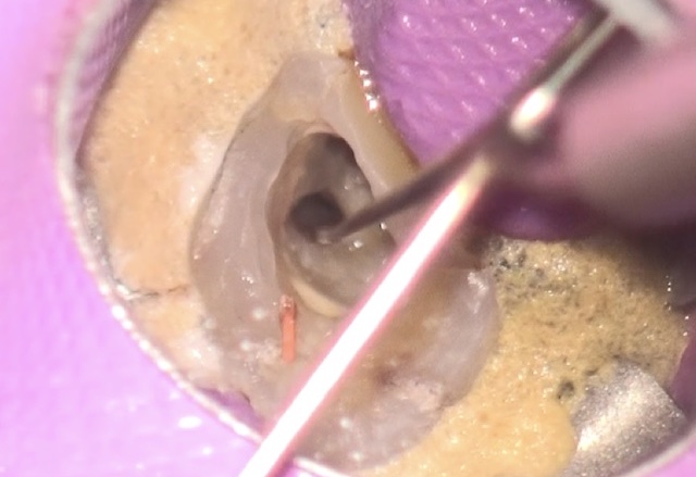 根幹治療の症例写真