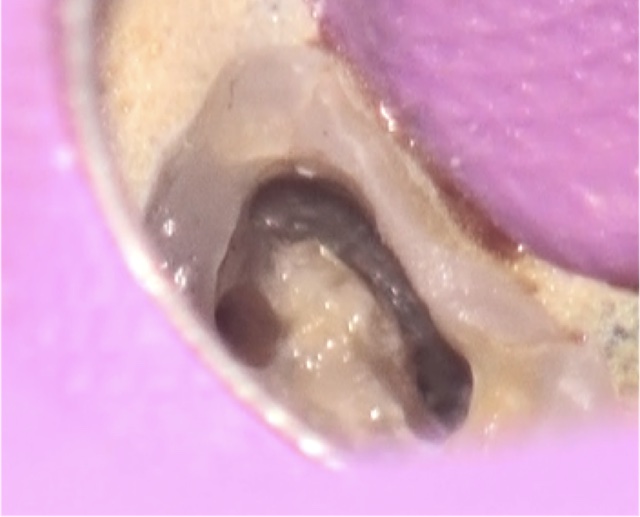 根幹治療の症例写真