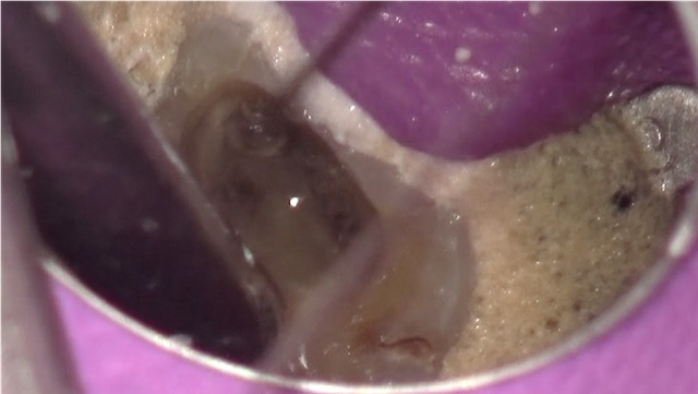 根幹治療の症例写真