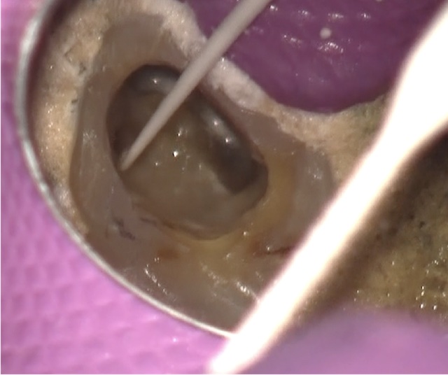 根幹治療の症例写真