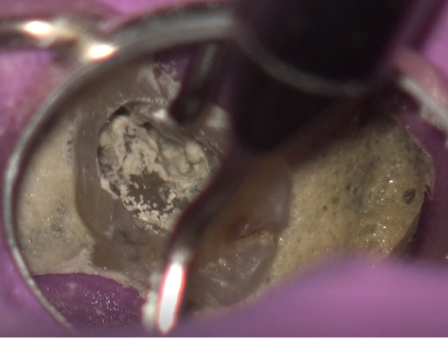 根幹治療の症例写真