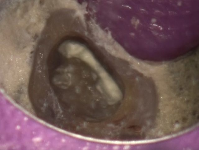 根幹治療の症例写真