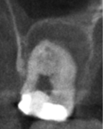 根幹治療の症例写真