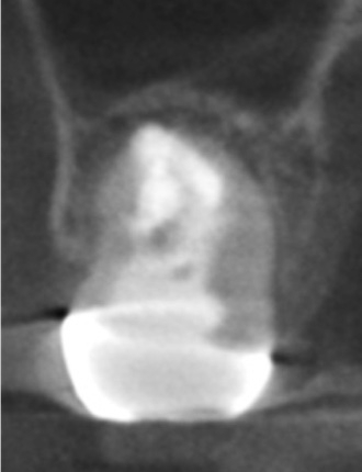 根幹治療の症例写真