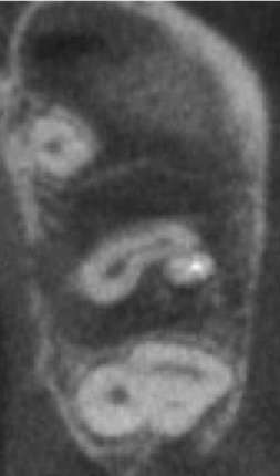 根幹治療の症例写真