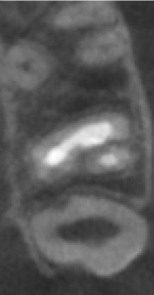 根幹治療の症例写真