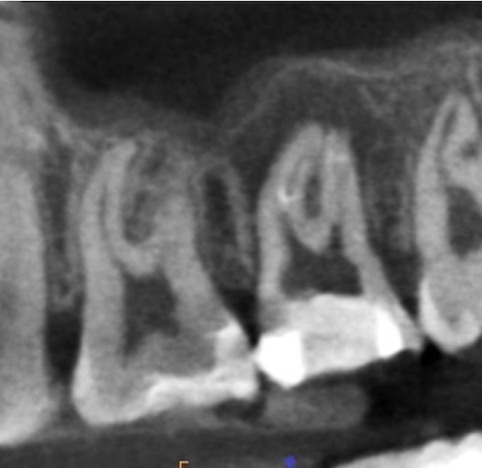 根幹治療の症例写真