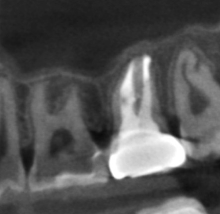 根幹治療の症例写真