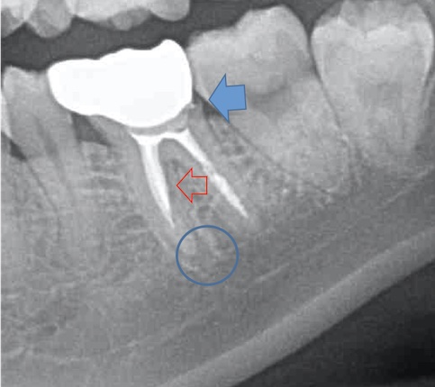 根幹治療の症例写真