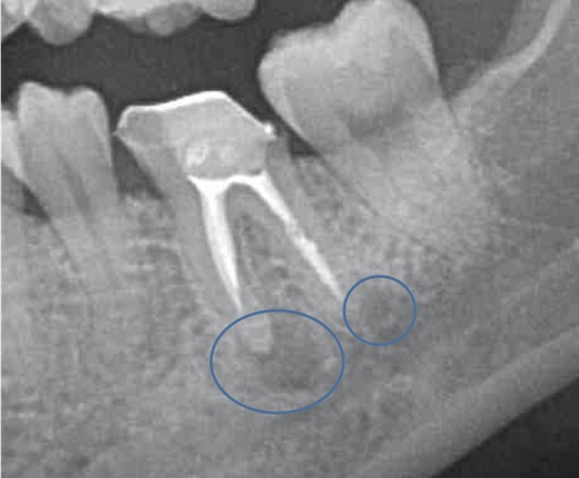 根幹治療の症例写真