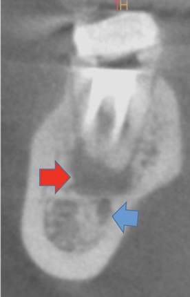 根幹治療の症例写真